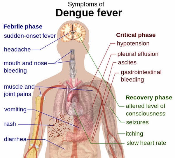 Dengue fever entails many severe symptoms Dengue fever entails many severe symptoms